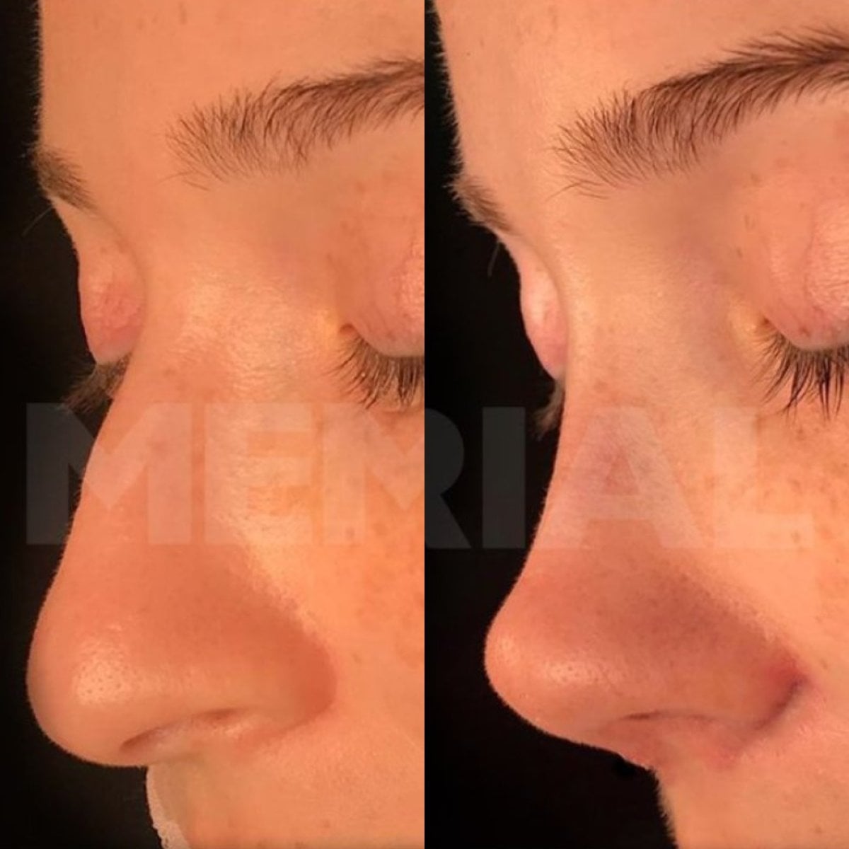 نتائج قبل وبعد تجميل الأنف بالموجات فوق الصوتية في مستشفى ميموريال بهجيليفلر