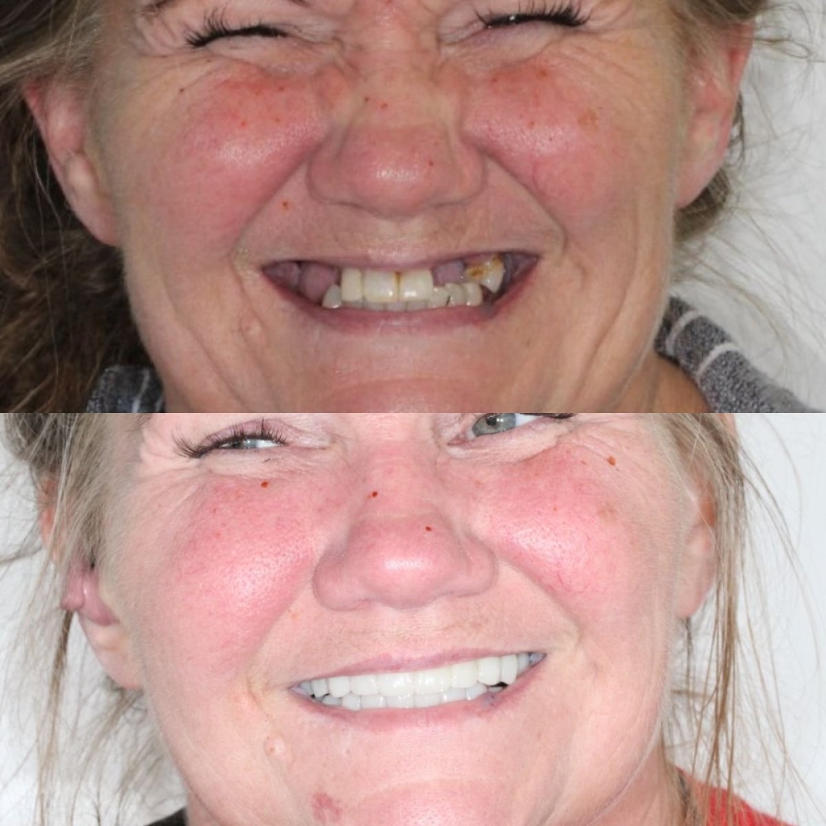 نتائج قبل وبعد طقم الأسنان في Ivan Implant and Cosmetic Dental – ابتسامة مستعادة