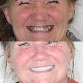 Результаты до и после протезирования в Ivan Implant and Cosmetic Dental – восстановленная улыбка
