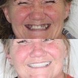 Результаты до и после протезирования в Ivan Implant and Cosmetic Dental – восстановленная улыбка