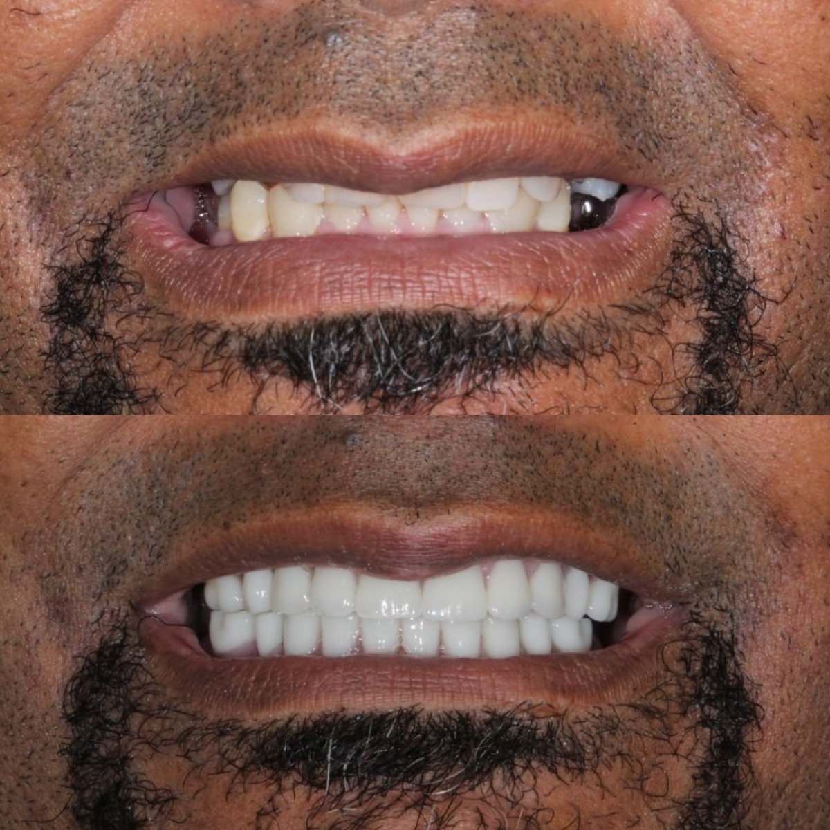 Resultados antes y después de dentadura en Ivan Implant and Cosmetic Dental, sonrisa mejorada