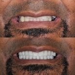 Результаты до и после протезирования в Ivan Implant and Cosmetic Dental, улучшение улыбки