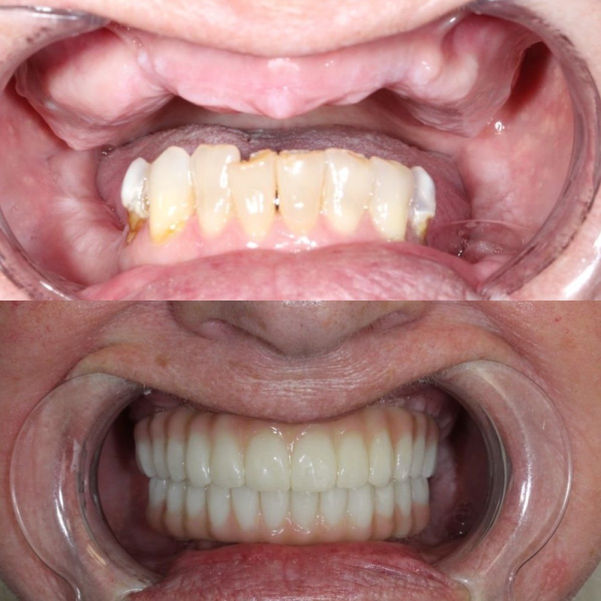 Resultados de dentadura antes y después en Ivan Implant and Cosmetic Dental, restauración total de sonrisa
