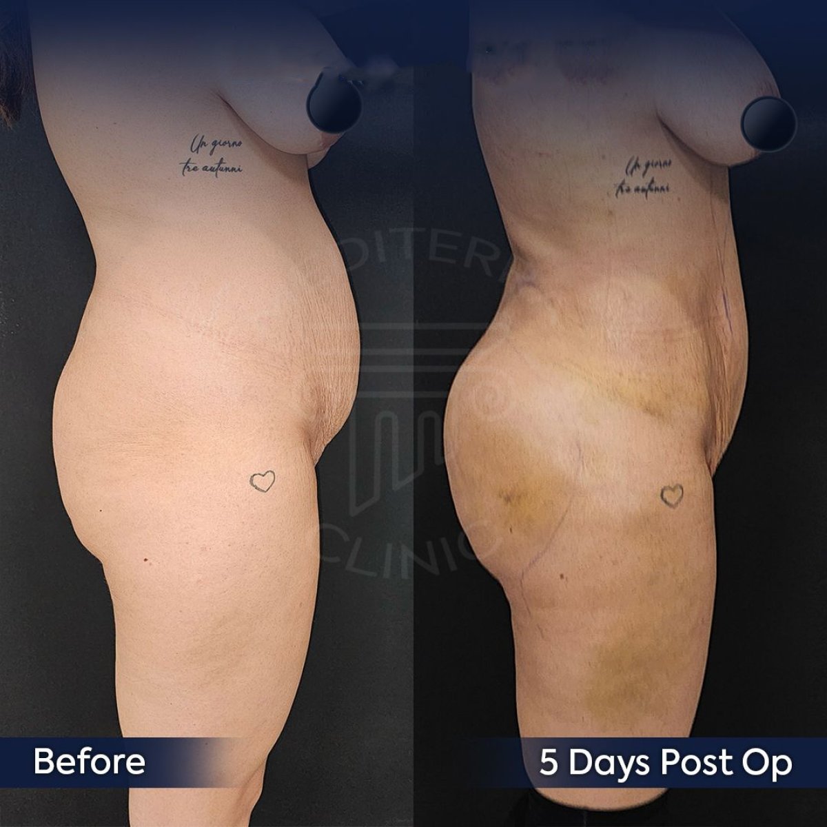 نتائج قبل وبعد عملية Brazilian Butt Lift في عيادة Dr. Safa Manav، تحسين شكل الجسم