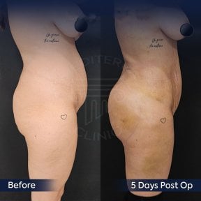 Результаты до и после Brazilian Butt Lift в клинике Dr. Safa Manav, улучшенный контур тела