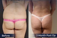 Результаты до и после Brazilian Butt Lift в клинике Dr. Safa Manav, 3 месяца после