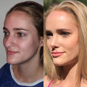 Before and after facial feminization surgery results at Dr. Safa Manav Clinic, refined features