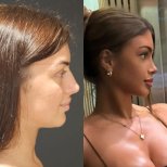 Before and after facial feminization surgery results at Dr. Safa Manav Clinic, profile view