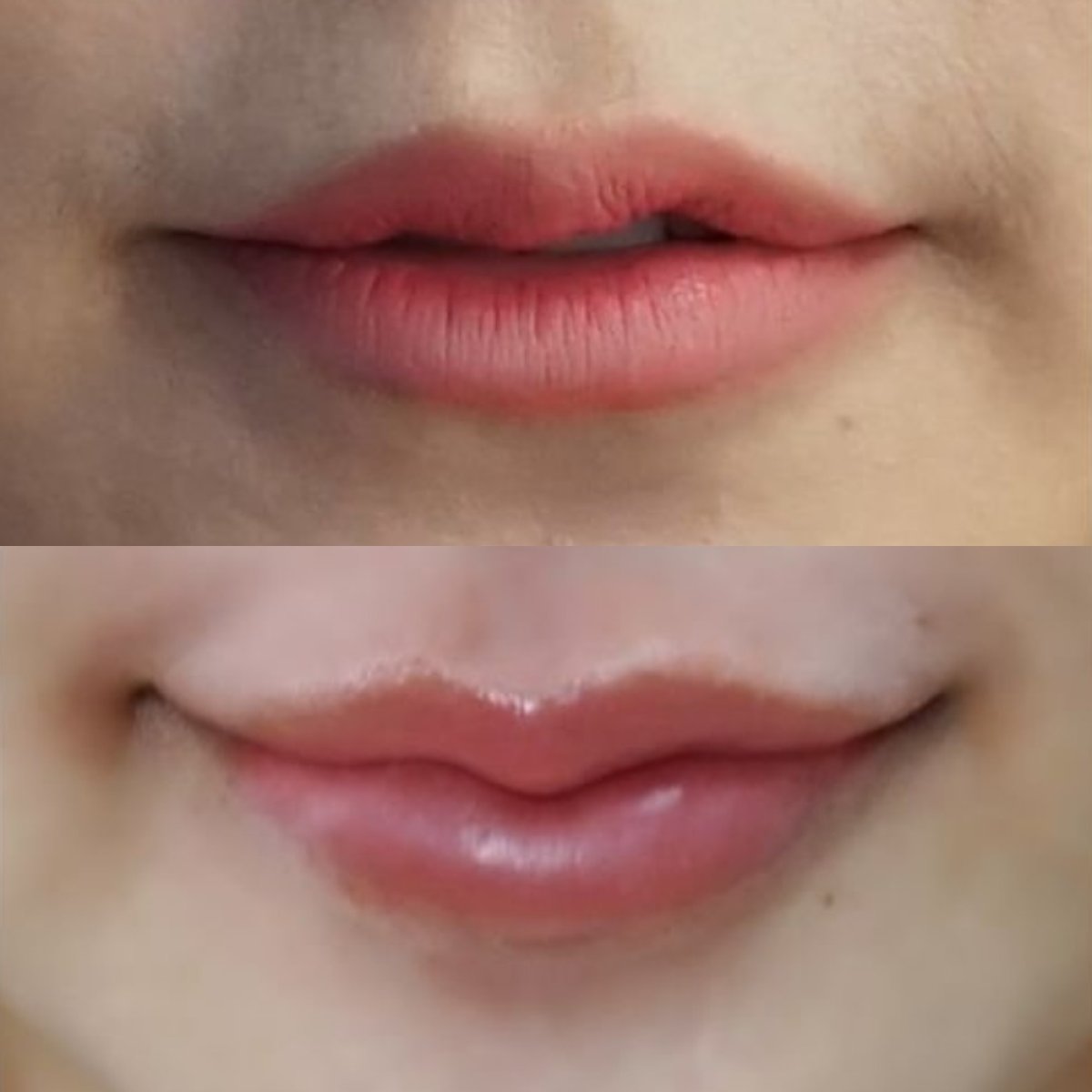 نتائج قبل وبعد رفع الشفاه في Asia Cosmetic Hospital، تحسين شكل الشفاه