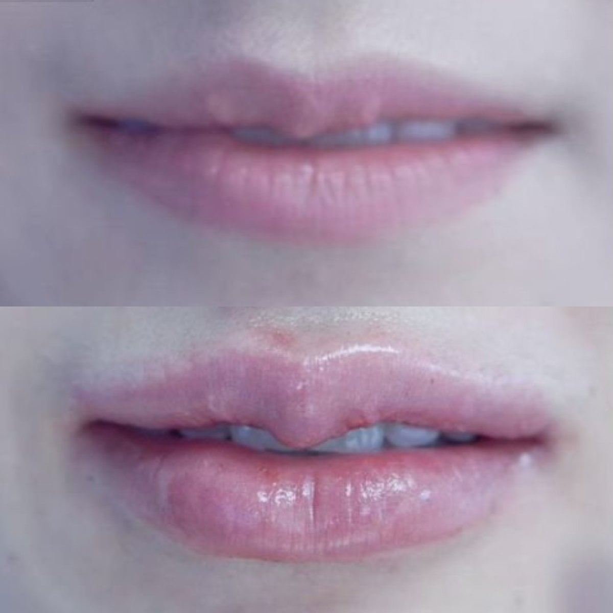 Resultados de antes y después de lip lift en Asia Cosmetic Hospital, labios más definidos