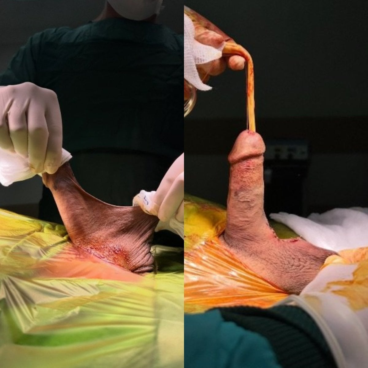 نتائج قبل وبعد رأب الصفن في Uroaesthetic – مظهر صفن محسّن