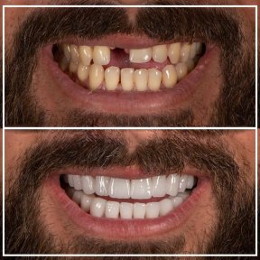 Vorher-nachher-Ergebnis Zirkonkrone bei My Nova Kusadasi Dental Clinic, Lächeln erneuert