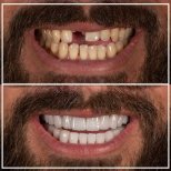 Vorher-nachher-Ergebnis Zirkonkrone bei My Nova Kusadasi Dental Clinic, Lächeln erneuert