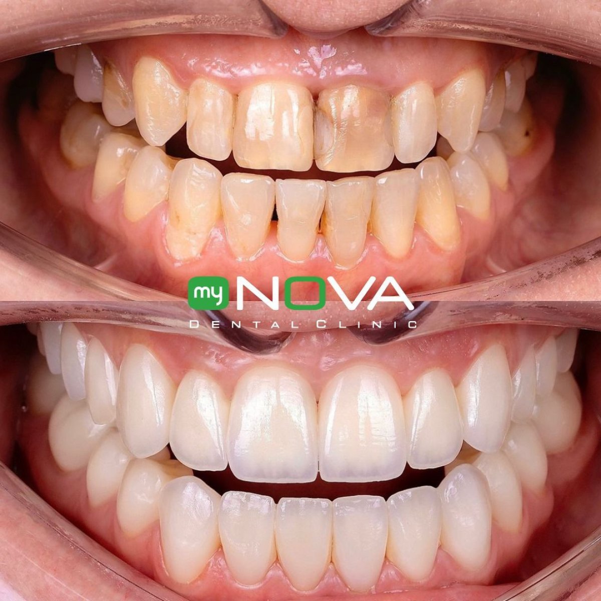 نتائج قبل وبعد تركيب تيجان الزركونيا في My Nova Kusadasi Dental Clinic، تحول الابتسامة
