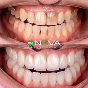 Vorher-nachher-Ergebnis Zirkonkrone bei My Nova Kusadasi Dental Clinic, Lächeln-Transformation