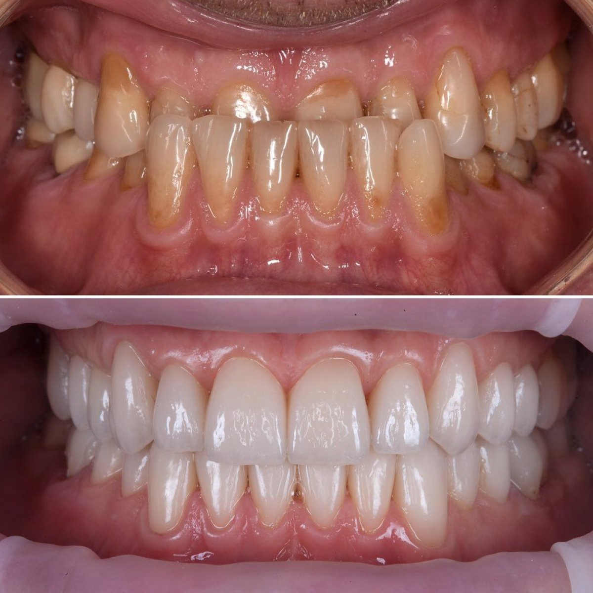 نتائج قبل وبعد تركيب تيجان الزركونيا في My Nova Kusadasi Dental Clinic، استعادة الابتسامة
