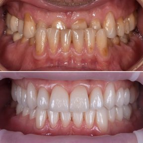Vorher-nachher-Ergebnis Zirkonkrone bei My Nova Kusadasi Dental Clinic, Lächeln restauriert