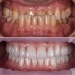 Vorher-nachher-Ergebnis Zirkonkrone bei My Nova Kusadasi Dental Clinic, Lächeln restauriert