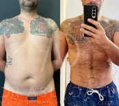 Vorher-nachher Bauchmuskel-Etching bei Liv Hospital Ulus, sichtbares Sixpack-Ergebnis