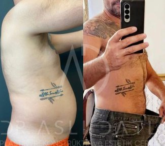 Vorher-nachher-Ergebnis Bauchmuskel-Etching bei Liv Hospital Ulus, sichtbare Sixpack-Resultate