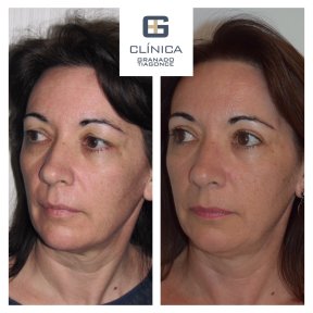 Before and after lower eyelid blepharoplasty results at Clinica Granado Tiagonce, rejuvenation