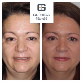 Before and after lower eyelid blepharoplasty at Clinica Granado Tiagonce, rejuvenation result