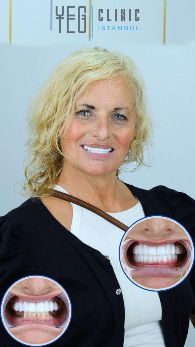 Resultados de instalación de dentaduras completas en YEG Clinic, mejora estética de la sonrisa