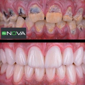 Vorher-nachher-Ergebnis Zirkonkrone bei My Nova Kusadasi Dental Clinic, Lächeln restauriert