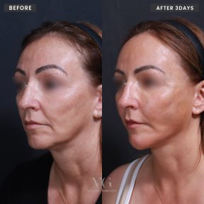 Before and after threads lifting at VG Plastic Surgery, visible facial contour improvement result