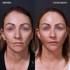 Before and after thread lifting results at VG Plastic Surgery, facial rejuvenation in 3 days
