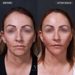 Before and after thread lifting results at VG Plastic Surgery, facial rejuvenation in 3 days