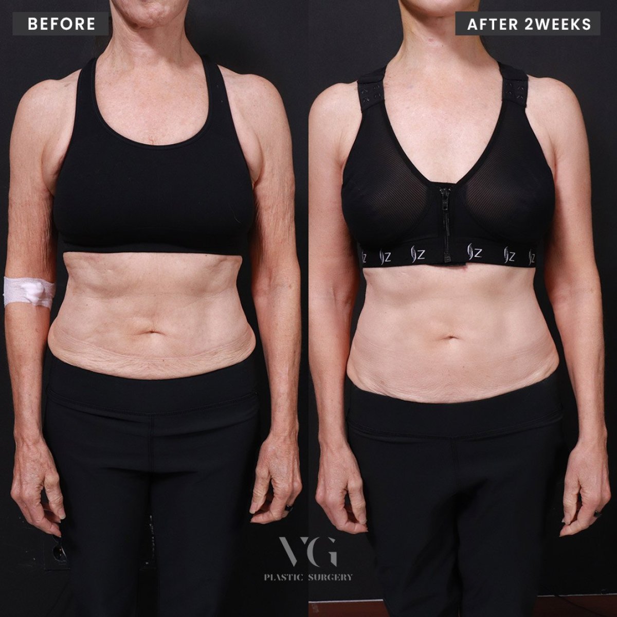 نتائج شد الذراعين قبل وبعد في VG Plastic Surgery، تحسين شكل الذراع