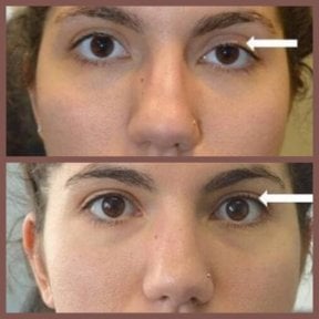 Before and after droopy eyelid surgery results at ID Clinic Bangkok, improved eyelid symmetry