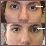 Before and after droopy eyelid surgery results at ID Clinic Bangkok, improved eyelid symmetry