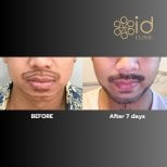 Before and after beard transplant results at ID Clinic Bangkok, fuller beard after 7 days