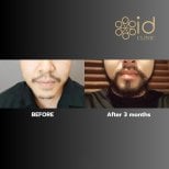 Before and after beard transplant results at ID Clinic Bangkok, fuller beard after 3 months