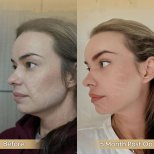 Vorher-nachher-Ergebnis eines Brow Lifts in der Dr. Safa Manav Klinik, 5 Monate postoperativ