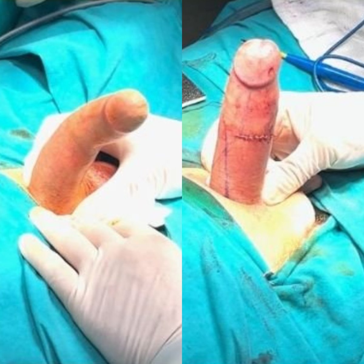 نتائج قبل وبعد جراحة زرع القضيب في Uroaesthetic، تحسين ملحوظ