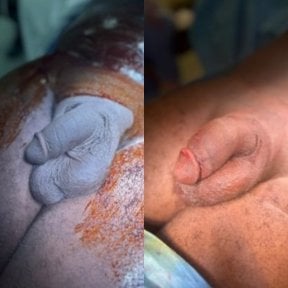 Before and after penis enlargement results at Uroaesthetic clinic, visible size improvement