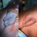 Before and after penis enlargement results at Uroaesthetic clinic, visible size improvement