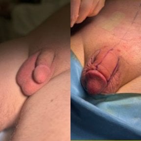 Before and after penis enlargement results at Uroaesthetic clinic, visible size improvement