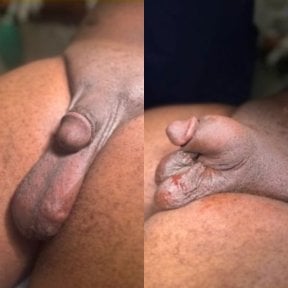 Before and after scrotoplasty results at Uroaesthetic, improved scrotal appearance