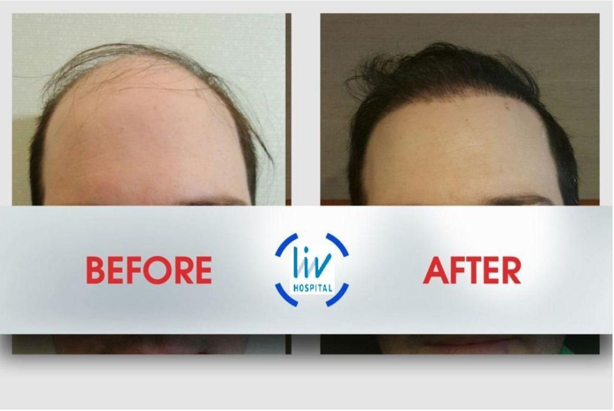 Vorher-nachher-Ergebnisse der Haartransplantation bei Liv Hospital Ulus, verbesserter Haaransatz