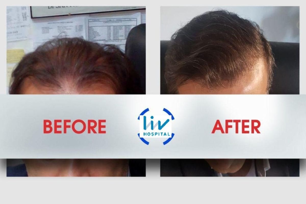 Vorher-nachher-Ergebnis der Haartransplantation bei Liv Hospital Ulus, dichtere Haarlinie