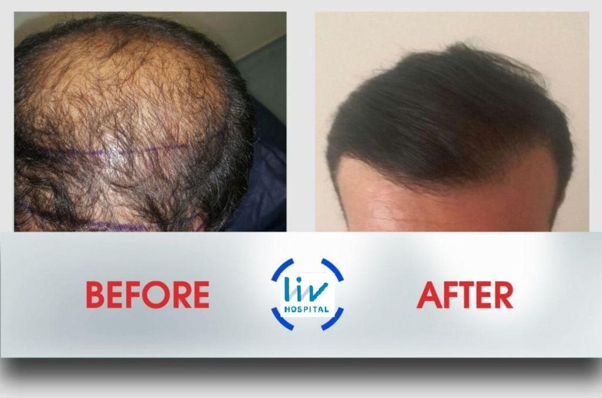 Vorher-nachher-Ergebnis einer Haartransplantation bei Liv Hospital Ulus mit vollerem Haar