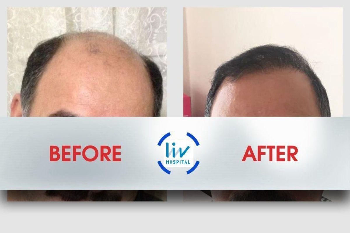 Vorher-nachher-Ergebnis Haartransplantation bei Liv Hospital Ulus, wiederhergestellte Haarlinie