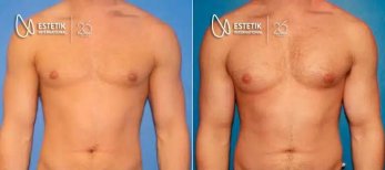 نتائج قبل وبعد زراعة عضلات الصدر في Estetik International Istanbul وتحسين شكل الصدر