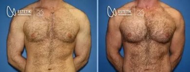 نتائج قبل وبعد زراعة عضلات الصدر في عيادة Estetik International Istanbul وتحسين شكل الصدر