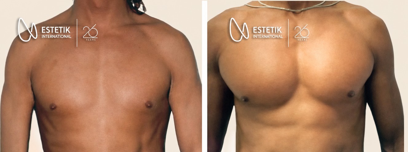 Resultados antes y después de implantes pectorales en Estetik International Istanbul