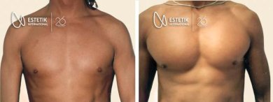 نتائج قبل وبعد زراعة عضلات الصدر في عيادة Estetik International Istanbul